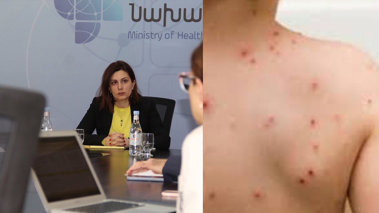 ՀՀ առողջապահության նախարարության նախազգուշացումը կատաղության մասին